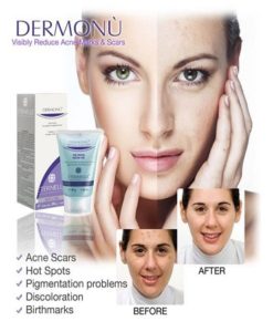 Dermonu Acne Removal Cream in Pakistan